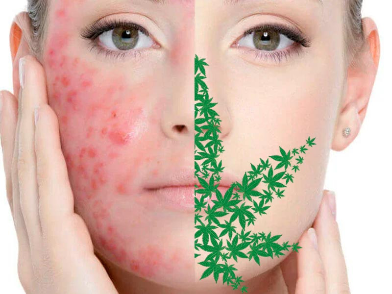 Средства с коноплей против прыщей Конопля и угревая сыпь
